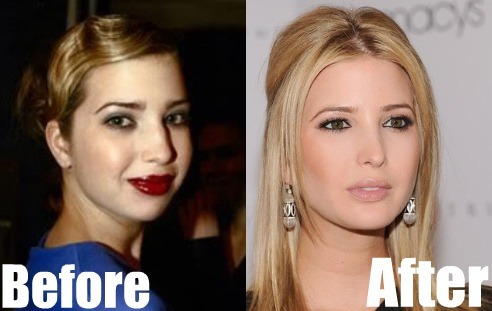 Ivanka Plastic Surgery Before and After.jpg
